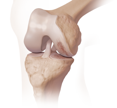 Knee arthritis 0 large