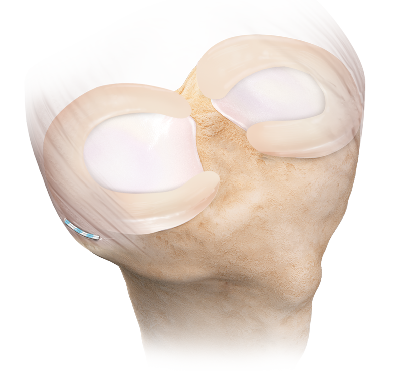 Arthrex Knee Replacement Recall – LRBO