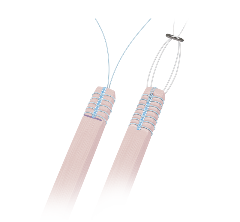 Arthrex FiberLoop® with FiberTag™ Suture