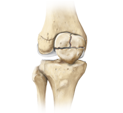 Knee fracture repair 0 large