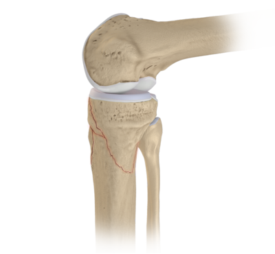 Knee fracture repair 1 large