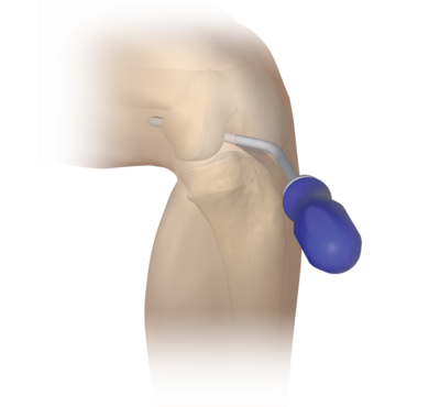 Knee Obturator for Posterior Portals