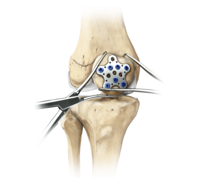 Knee patella sutureplate 0 large