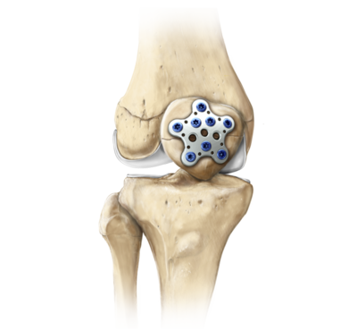 Knee patella sutureplate technique 0 large