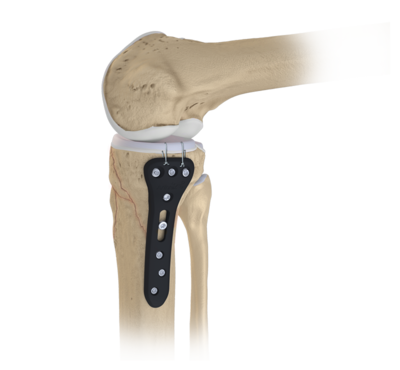 Knee peekpower tibial head fracture technique 0 large