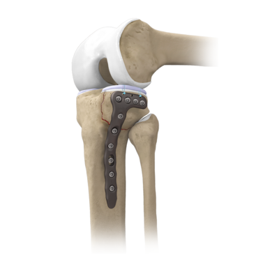 Knee peekpower tibial head fracture technique 1 large