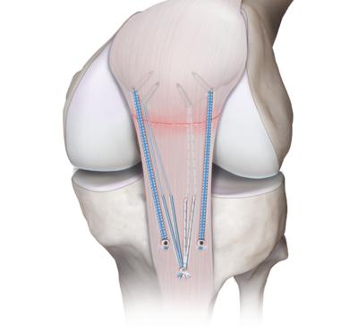 Knee tendon repair 1 large