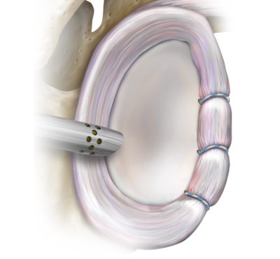 Knotless SutureTak® Anchor Technique