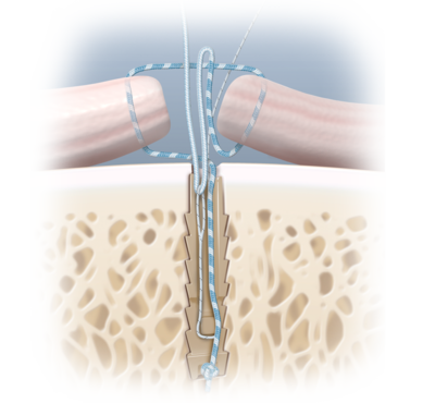Lateral epicondylitis repair 0 large