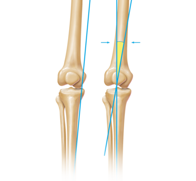 Limb deformity 0 large