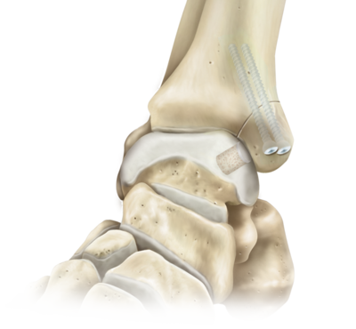 medial malleolus osteotomy arthrex ankle oats talus osteochondral evaluation quote foot