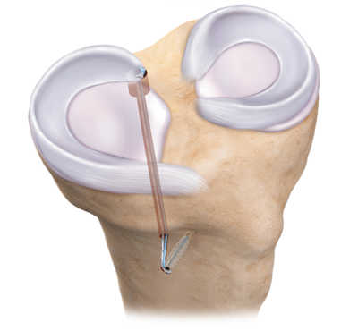 Meniscal Root Repair