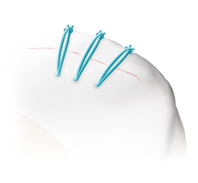 Meniscal viper all inside repair 0 large