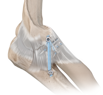 Open elbow reconstruction augmentation 0 large