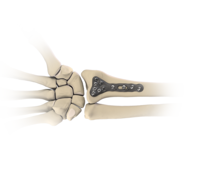 Osteosynthesis peekpower distal radius plate 0 large