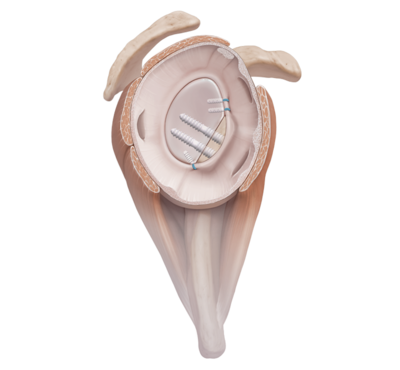 Parallel drill guide biocompression screw 0 large