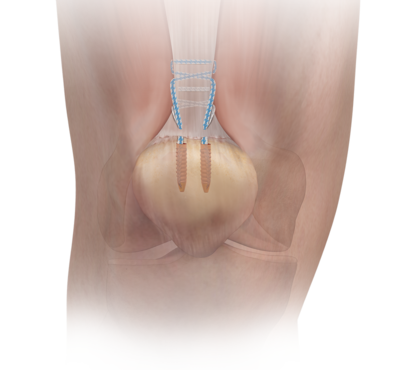 Pars quadriceps repair 0 large