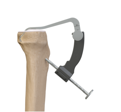 PCL Soft Tissue Graft Fixation