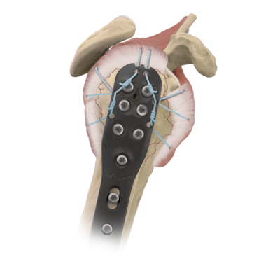 Peekpower humeral fracture plate prod 1 large