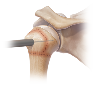 arthrex percutaneous pinning