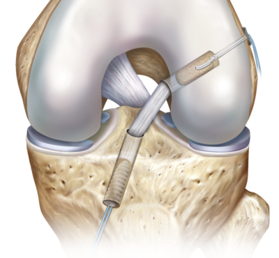 Retrobutton btb 0 large