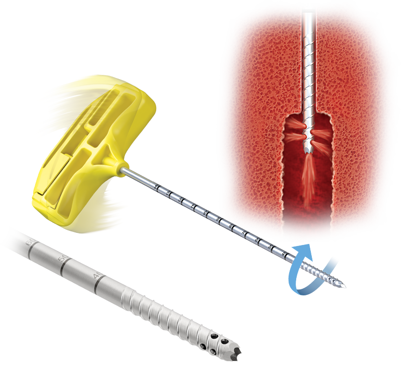 Deathpair （ex.ZEILE） / 血核 Arthrex - Cellular Therapies