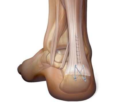 Suturebridge and speedbridge 0 large