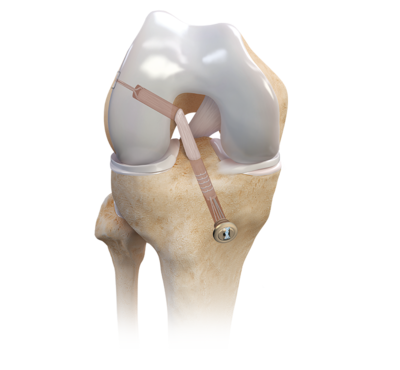 TensionLoc® Implant System