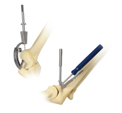 Ucl reconstruction 0 large