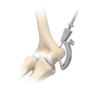 Ucl reconstruction 1 large