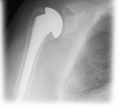 Univers 2 total shoulder system 1 large