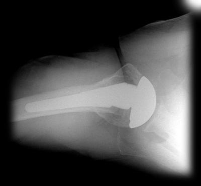 Univers 2 total shoulder system 2 large