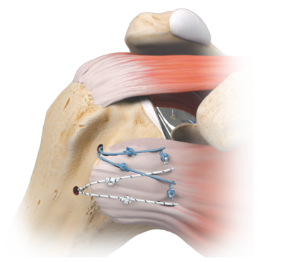 Univers apex 2 large