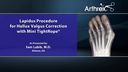 Lapidus Procedure for Hallux Valgus Correction with Mini TightRope®