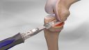 Partial Knee Replacement with the iBalance® UKA
