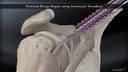 Proximal Biceps Repair using SwiveLock®  Tenodesis