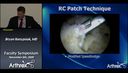 Rotator Cuff Allograft: Augmentation and Bridging Technique
