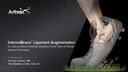 InternalBrace™ Ligament Augmentation for Lateral Ankle Instability (Insertion Order Talus to Fibula)
