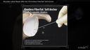 Shoulder Labral Repair With the 1.8 Knotless FiberTak® Soft Anchor