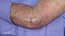 Lateral Epicondylitis Debridement and Repair