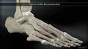 Lateral Ankle Reconstruction
