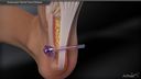 Endoscopic Plantar Fascia Release