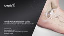 Three-Portal Brostrom-Gould - Lateral Ankle Repair with the Mini ScorpionTM DX