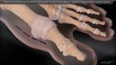 Hallux Varus Deformity Correction Utilizing the Forefoot InternalBrace™ Ligament Augmentation Implant System