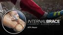 When You Treat Sports Injuries Think InternalBrace™ Ligament Augmentation