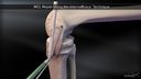 InternalBrace™ MCL Augmentation Repair
