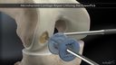 Microfracture Cartilage Repair Utilizing the PowerPick™