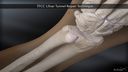 TFCC Ulnar Tunnel Repair Technique