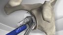 Total Shoulder Replacement with Univers™ II System
