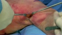 Minimally Invasive Hamstring Harvest Through a Posterior Incision